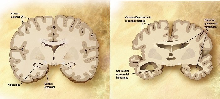 MatemáticaAlzheimer_Interna2